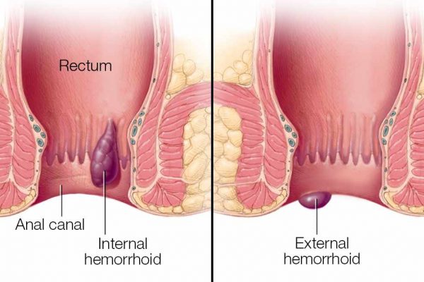Internal and External Hemorrhoid Diagram