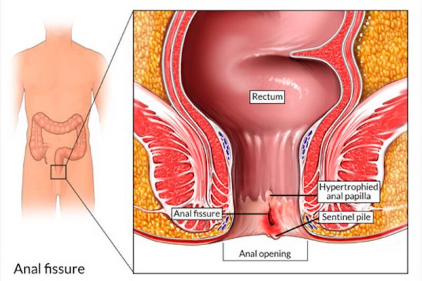 Anal Fissure Diagram