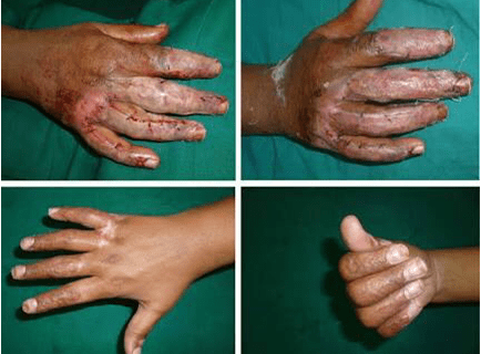 Burn Reconstruction Procedures
