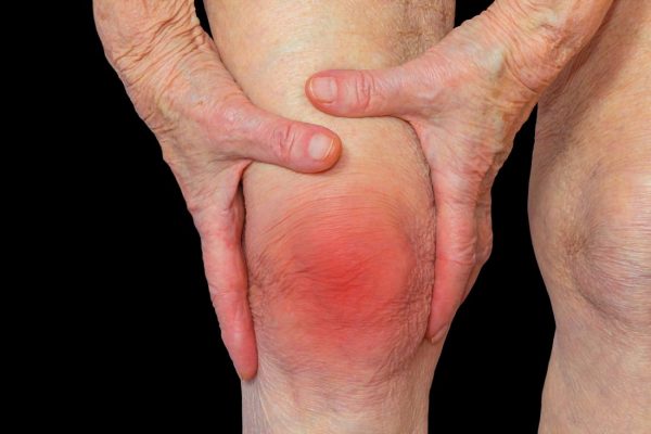 Arthritis Pain