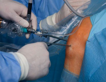 Arthroscopic Knee Surgery